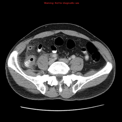 File:Appendicitis and renal cell carcinoma (Radiopaedia 17063-16760 A 40).jpg