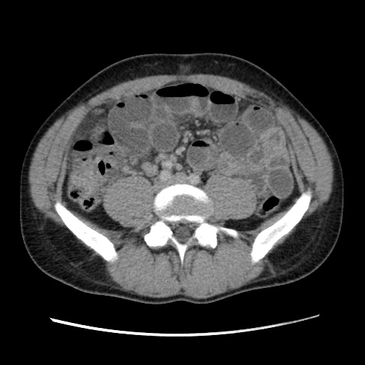 Appendicitis complicated by post-operative collection (Radiopaedia 35595-37114 A 54).jpg