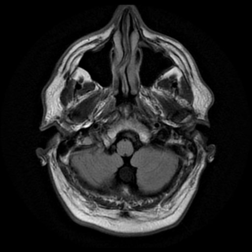 File:Aqueduct stenosis with corpus callosum hypoattenuation post shunting (Radiopaedia 37212-38969 Axial FLAIR 3).png