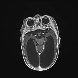 Aqueductal stenosis (Radiopaedia 73974-84802 Axial T1 C+ 70).jpg