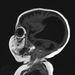 File:Aqueductal stenosis (Radiopaedia 73974-84802 Sagittal T1 5).jpg