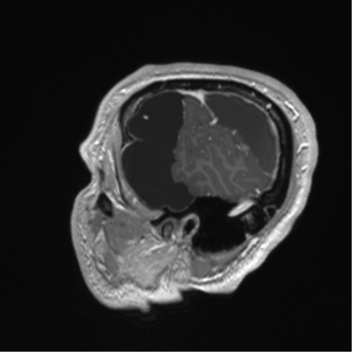 Arachnoid cyst with subdural hematoma (Radiopaedia 85892-101743 Sagittal T1 C+ 16).png