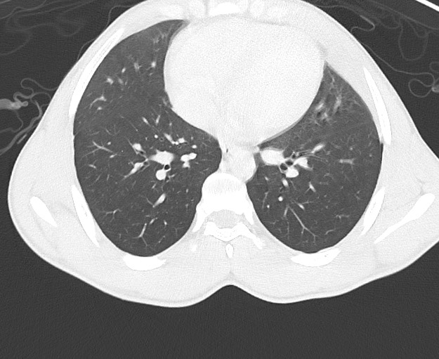 Arrow injury to the chest (Radiopaedia 75223-86321 Axial lung window 54).jpg