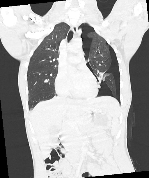 Arrow injury to the chest (Radiopaedia 85367-100975 Coronal lung window 69).jpg