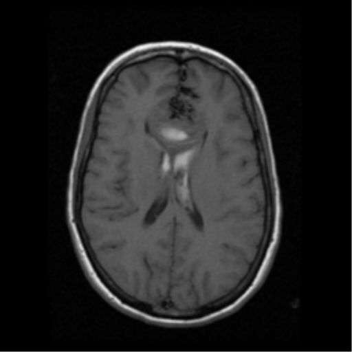 File:Arteriovenous malformation (cerebral) (Radiopaedia 40070-42580 Axial T1 13).png