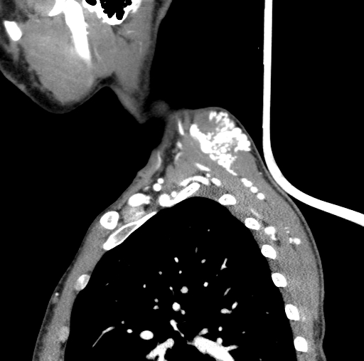 Arteriovenous malformation of the neck (Radiopaedia 53935-60062 C 16).jpg