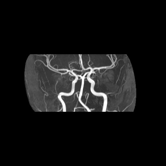 File:Artery of Percheron infarct (Radiopaedia 40966-43676 G 30).jpg