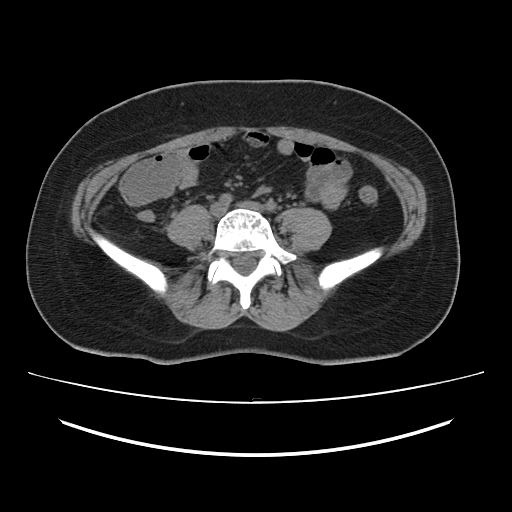 Ascending retrocecal appendicitis with liver abscesses (Radiopaedia 60066-67615 Axial non-contrast 56).jpg