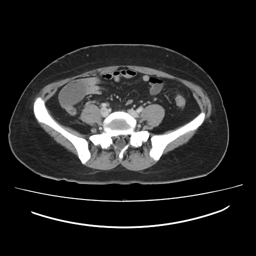 File:Ascending retrocecal appendicitis with liver abscesses (Radiopaedia 60066-67615 B 63).jpg