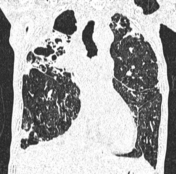 Aspergilloma- with Monod sign (Radiopaedia 44737-48532 Coronal lung window 231).jpg
