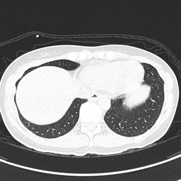 Aspergilloma (Radiopaedia 26223-26347 Axial lung window 61).jpg