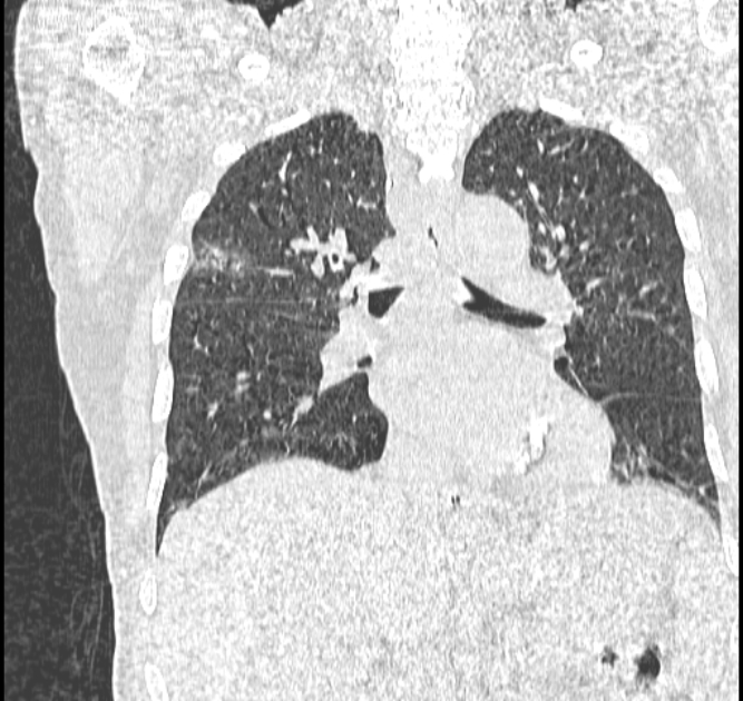 Aspergilloma (Radiopaedia 44592-48327 Coronal lung window 70).jpg