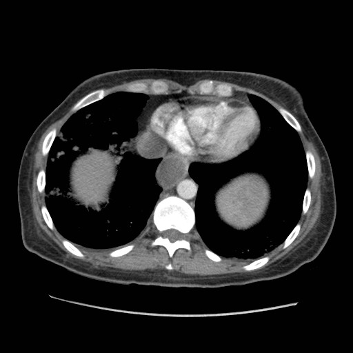 File:Aspiration pneumonia secondary to laparoscopic banding (Radiopaedia 18345-18183 A 42).jpg