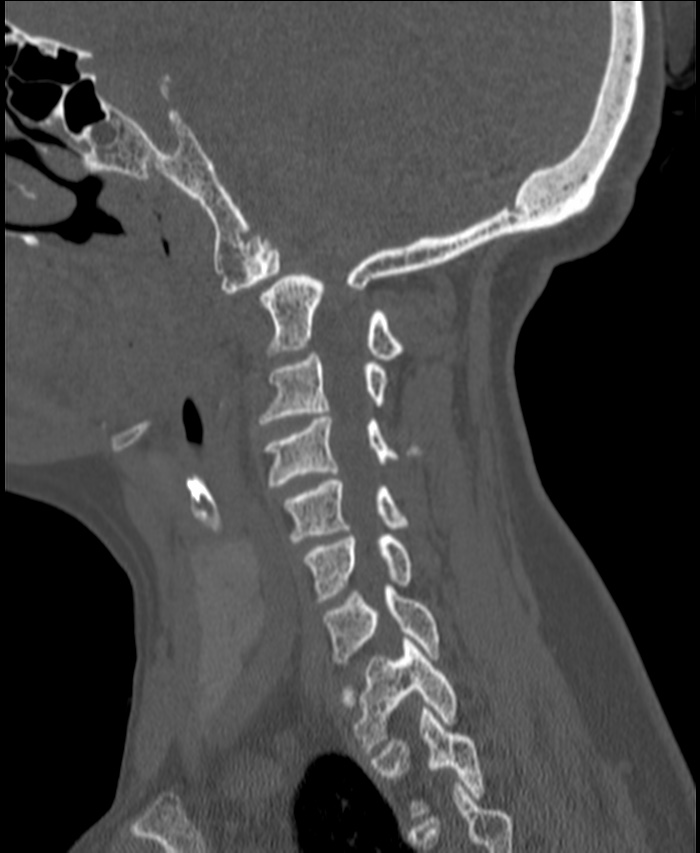 Atlanto-occipital assimilation with basilar invagination (Radiopaedia 70122-80188 Sagittal bone window 31).jpg