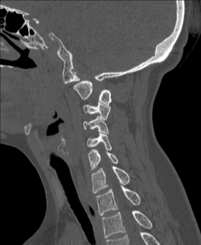 Atlanto-occipital assimilation with basilar invagination (Radiopaedia 70122-80188 Sagittal bone window 93).jpg