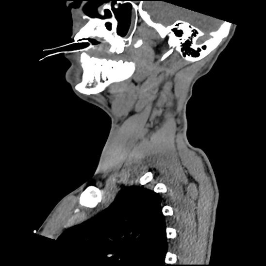 Atlanto-occipital dissociation (Traynelis type 1), C2 teardrop fracture, C6-7 facet joint dislocation (Radiopaedia 87655-104061 D 24).jpg