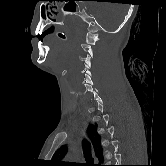 Atlanto-occipital dissociation (Traynelis type 1), C2 teardrop fracture, C6-7 facet joint dislocation (Radiopaedia 87655-104061 Sagittal bone window 26).jpg