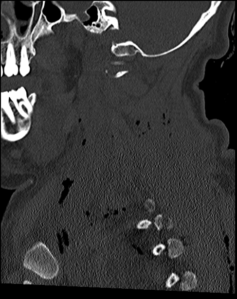 Atlanto-occipital dissociation - Traynelis type 1 (Radiopaedia 87570-103948 Sagittal bone window 32).jpg