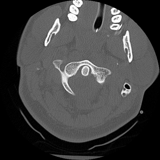 Atlanto-occipital dissociation injury (Radiopaedia 29274-29698 Axial bone window 15).png