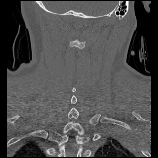 Atlanto-occipital dissociation injury (Radiopaedia 29274-29698 Coronal bone window 9).png