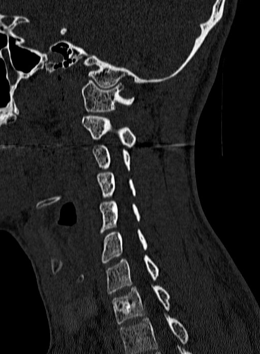 Atlantoaxial subluxation (Radiopaedia 44681-48450 Sagittal bone window 111).jpg