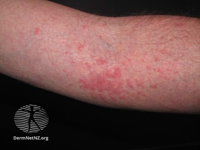 File:Atopic dermatitis (DermNet NZ dermatitis-flexural-eczema21).jpg