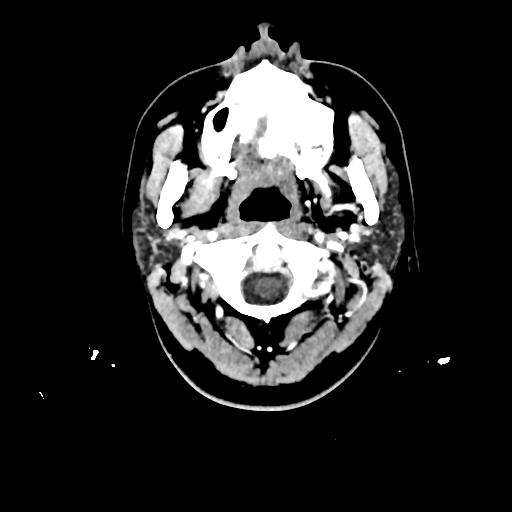 Atretic cephalocele (Radiopaedia 89782-106881 Axial with contrast 4).jpg