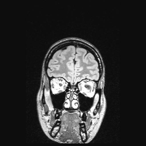 Atretic encephalocoele with inferior vermis hypoplasia (Radiopaedia 30443-31108 Coronal FLAIR 149).jpg