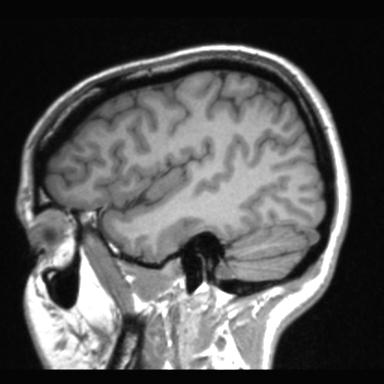 File:Atretic encephalocoele with inferior vermis hypoplasia (Radiopaedia 30443-31108 Sagittal T1 105).jpg