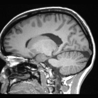 File:Atretic encephalocoele with inferior vermis hypoplasia (Radiopaedia 30443-31108 Sagittal T1 80).jpg