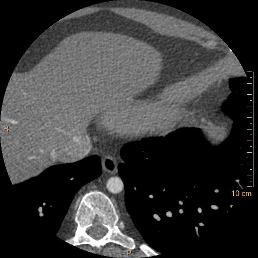 File:Atrial septal defect (upper sinus venosus type) with partial anomalous pulmonary venous return into superior vena cava (Radiopaedia 73228-83961 A 250).jpg