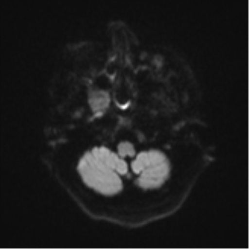 Atypical meningioma (WHO Grade II) (Radiopaedia 54742-60979 Axial DWI 33).png