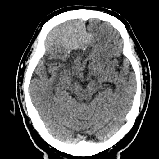 File:Atypical meningioma (WHO grade II) with brain invasion (Radiopaedia 57767-64728 Axial non-contrast 15).png