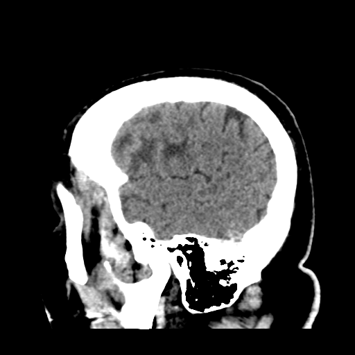 Atypical meningioma (WHO grade II) with brain invasion (Radiopaedia 57767-64728 Sagittal C+ 8).png