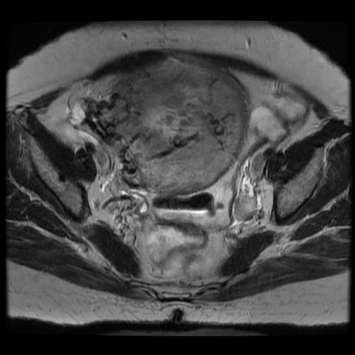 File:Atypical retroperitoneal lymphocoeles with large leiomyoma of uterus (Radiopaedia 32084-33027 Axial T2 20).jpg