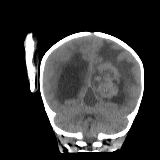 Atypical teratoid rhabdoid tumor (AT-RT) (Radiopaedia 85823-101654 Coronal non-contrast 37).jpg