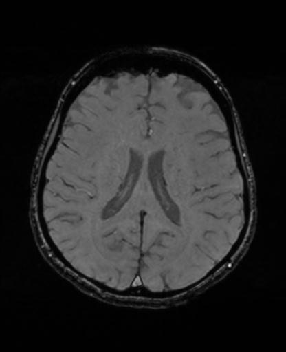 Autoimmune limbic encephalitis (Radiopaedia 30363-31005 SWI - magnitude 48).jpg