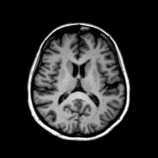Autoimmune limbic encephalitis (Radiopaedia 30363-31005 T1 Axial 1mm 87).jpg
