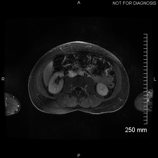 Autoimmune pancreatitis (Radiopaedia 88443-105101 A 91).jpg