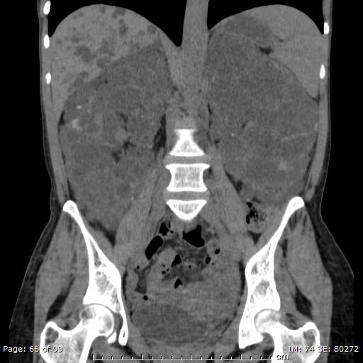 File:Autosomal dominant polycystic kidney disease (Radiopaedia 44122-47684 Coronal 10).jpg
