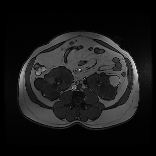 Autosomal dominant polycystic kidney disease (Radiopaedia 50259-55611 Axial 2D Dual Echo 57).jpg