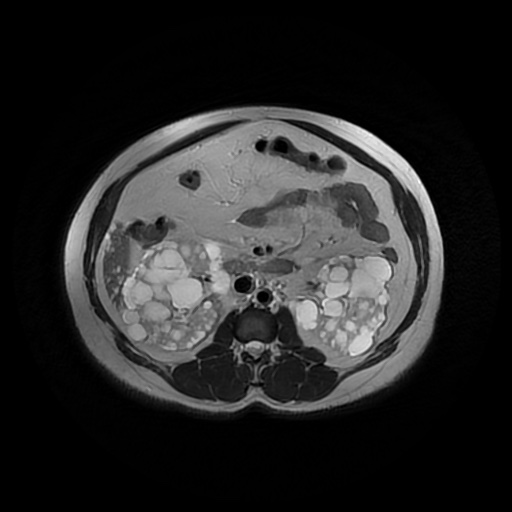 File:Autosomal dominant polycystic kidney disease (Radiopaedia 50259-55611 Axial T2 23).jpg