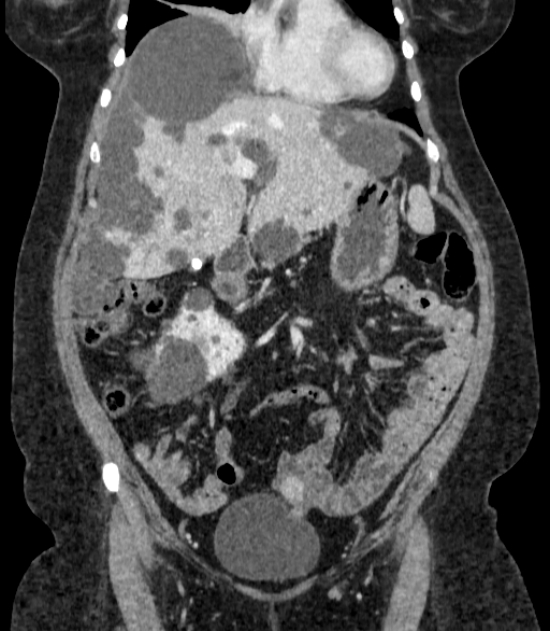 Autosomal dominant polycystic kidney disease (Radiopaedia 57124-64017 B 27).jpg