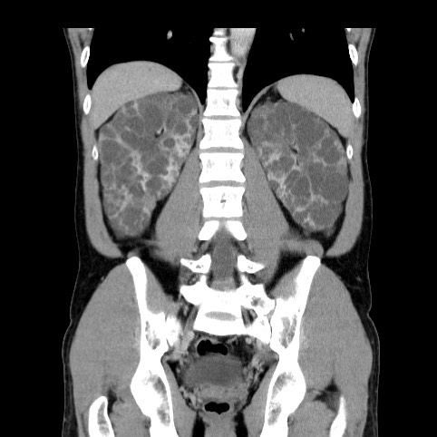 Autosomal dominant polycystic kidney disease (Radiopaedia 66349-75582 A 62).jpg