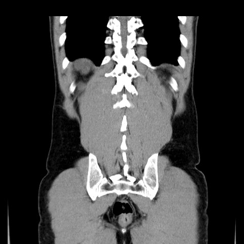 Autosomal dominant polycystic kidney disease (Radiopaedia 66349-75582 A 80).jpg
