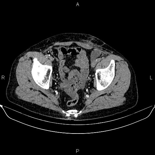 Autosomal dominant polycystic kidney disease (Radiopaedia 87830-104287 Axial non-contrast 50).jpg