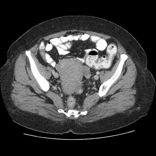 File:Autosomal dominant polycystic kidney disease with hepatic involvement (Radiopaedia 32693-33662 B 68).jpg