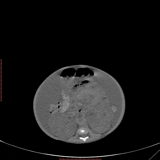 Autosomal recessive polycystic kidney disease associated with Caroli disease (Radiopaedia 61932-69984 B 224).jpg