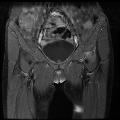 File:Avascular necrosis of the hip (Radiopaedia 29563-30067 I 3).jpg