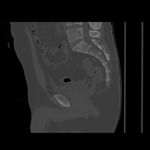 Avascular necrosis of the hip (Radiopaedia 61503-69467 B 30).jpg